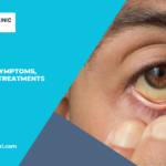 Understanding Jaundice Types, Causes, Symptoms, Diagnosis, and Treatments