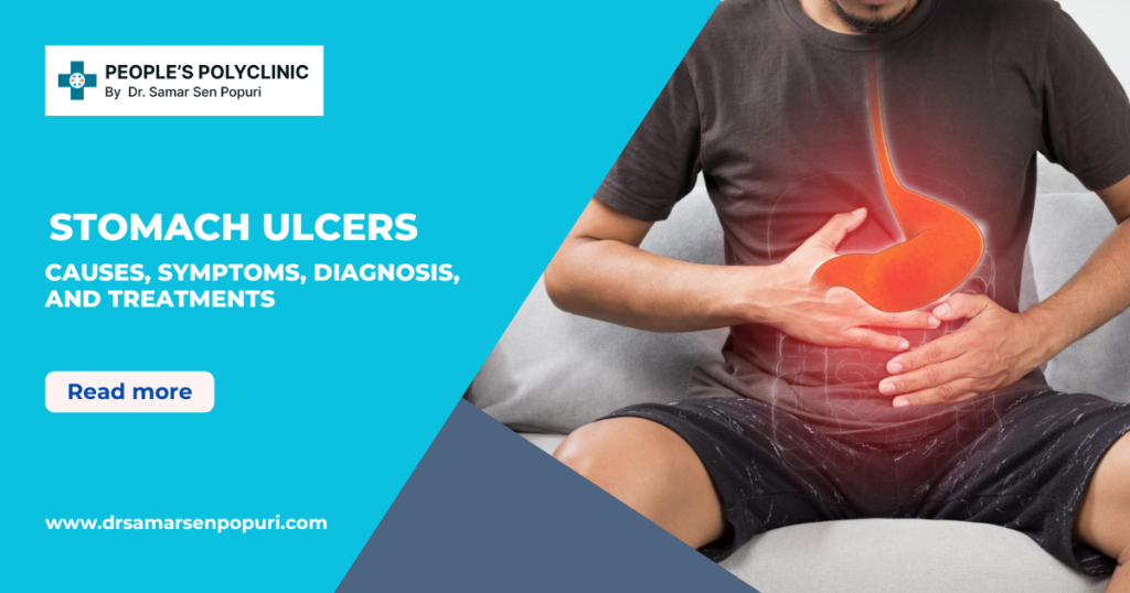 Understanding Stomach (Peptic) Ulcers: Causes, Symptoms, Diagnosis, and Treatments